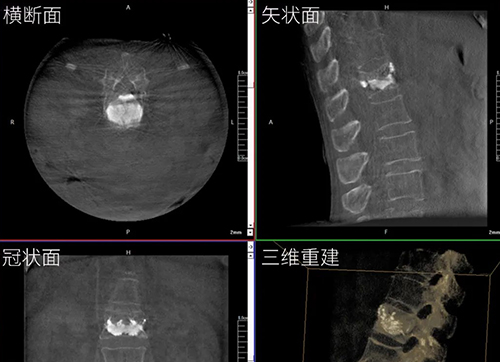 三維C形臂與二維C形臂臨床圖像實(shí)時(shí)對(duì)比
