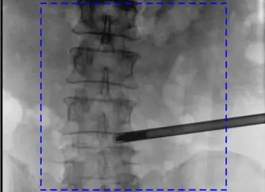 C臂機圖像不清楚的常見原因及解決辦法