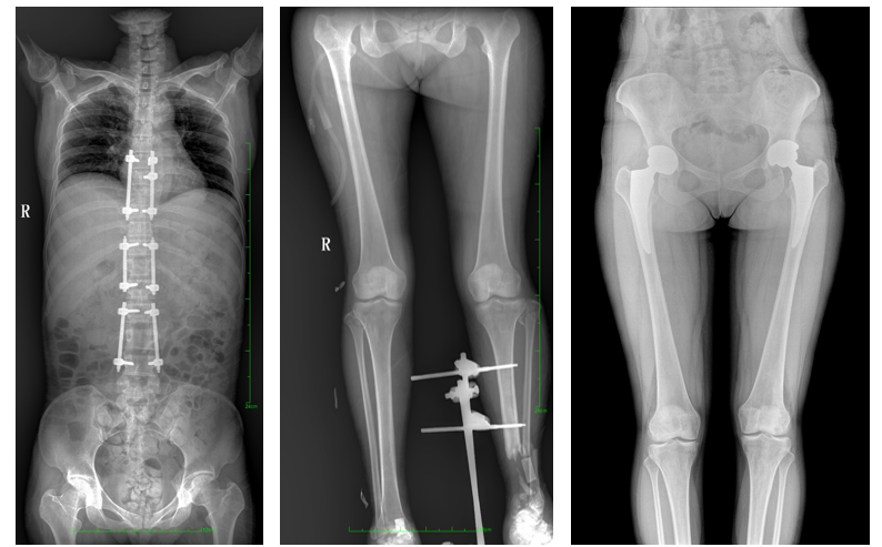 大視野平板動(dòng)態(tài)DR影像 大視野平板動(dòng)態(tài)DR影像