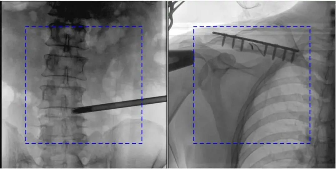 C臂機圖像不清楚